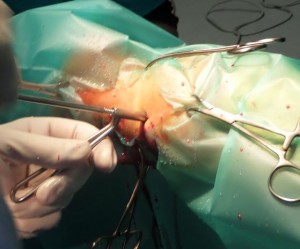 Zabieg chirurgiczny-  nawiercanie i gwintowanie otworów przygotowywanych do wkręcenia śrub.
